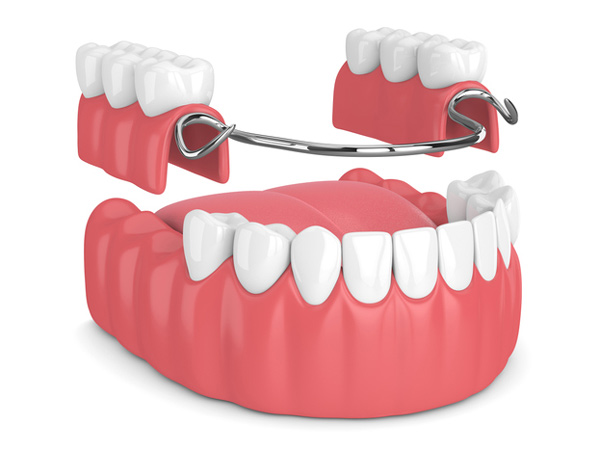 removable-partial-denture-drjcares-removable-partial-dentures