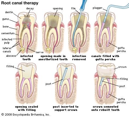 What Should One Expect After the Root Canal?